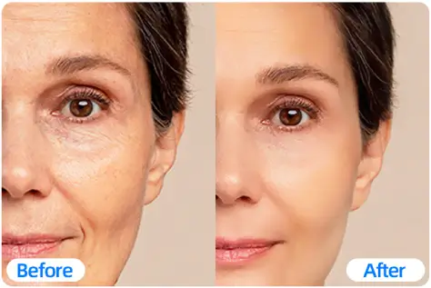 Remove skin blemishes